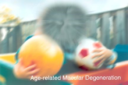 Two boys from the perspectie of having age-related macular degeneration (AMD)