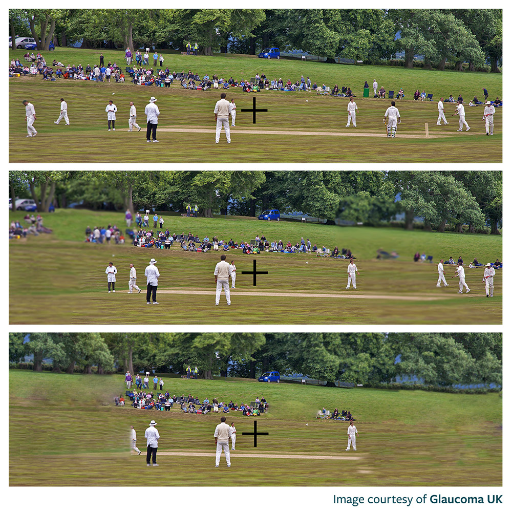 Three images simulating sight loss through Glaucoma. The images show the same cricket match but reduced detail in the periphery as severity increases. 